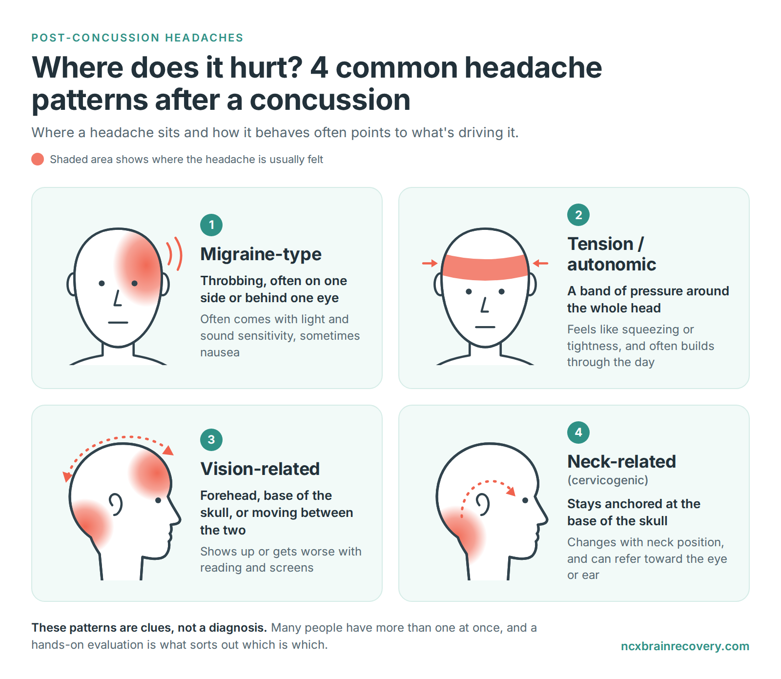 Diagram of four common headache patterns after a concussion, shown by where the pain is felt: migraine-type, tension/autonomic, vision-related, and neck-related.